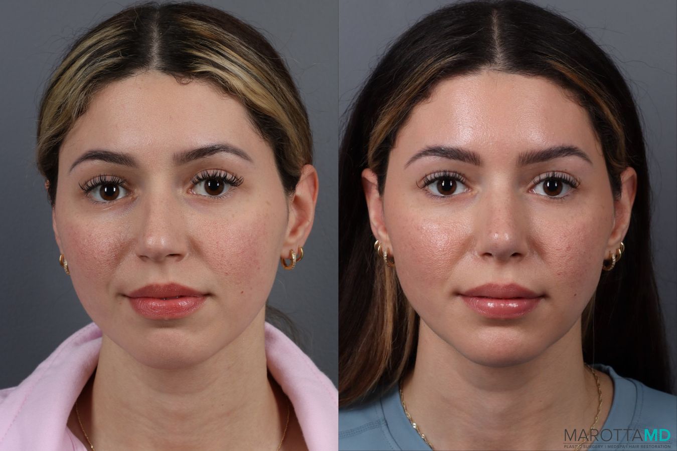 Before and after Rhinoplasty case 17177
