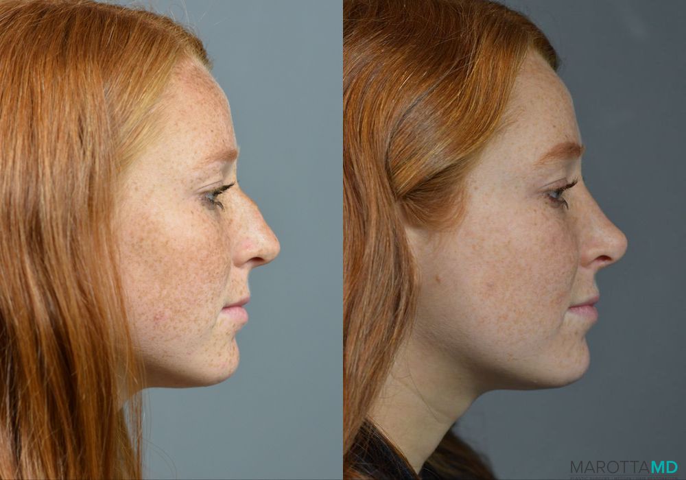 Rhinoplasty - Thumbnail 3