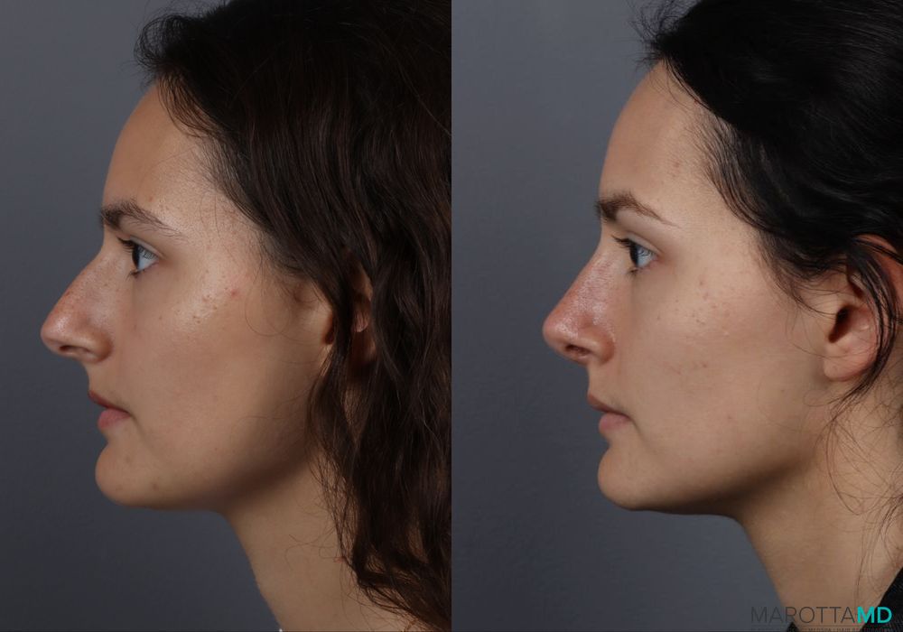 Rhinoplasty - Thumbnail 6