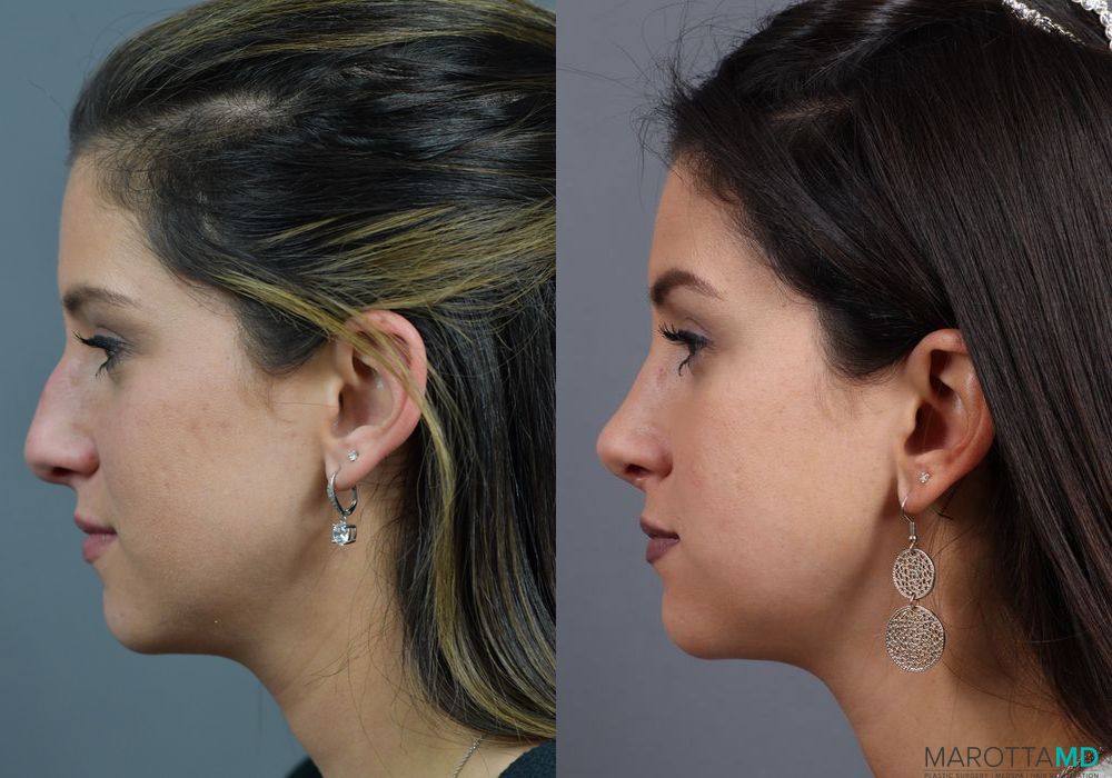 Rhinoplasty - Thumbnail 5