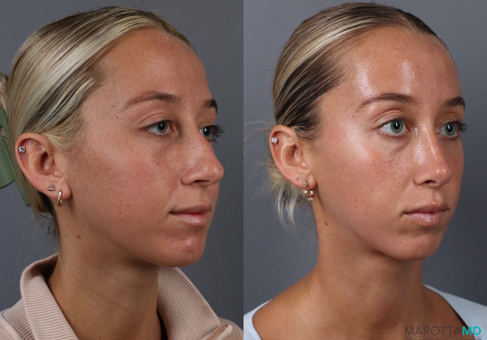 Rhinoplasty - Thumbnail 2