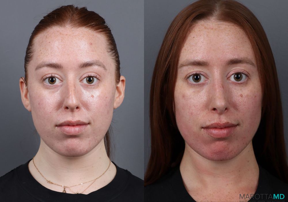 Rhinoplasty - Case 274