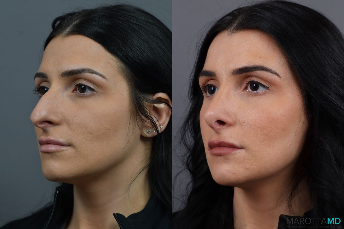 Before and after Rhinoplasty case 17406 - Angle 4
