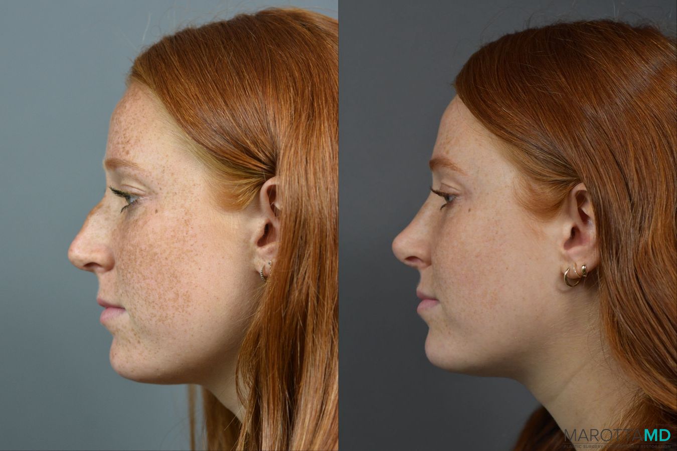 Before and after Rhinoplasty case 16102 - Angle 5
