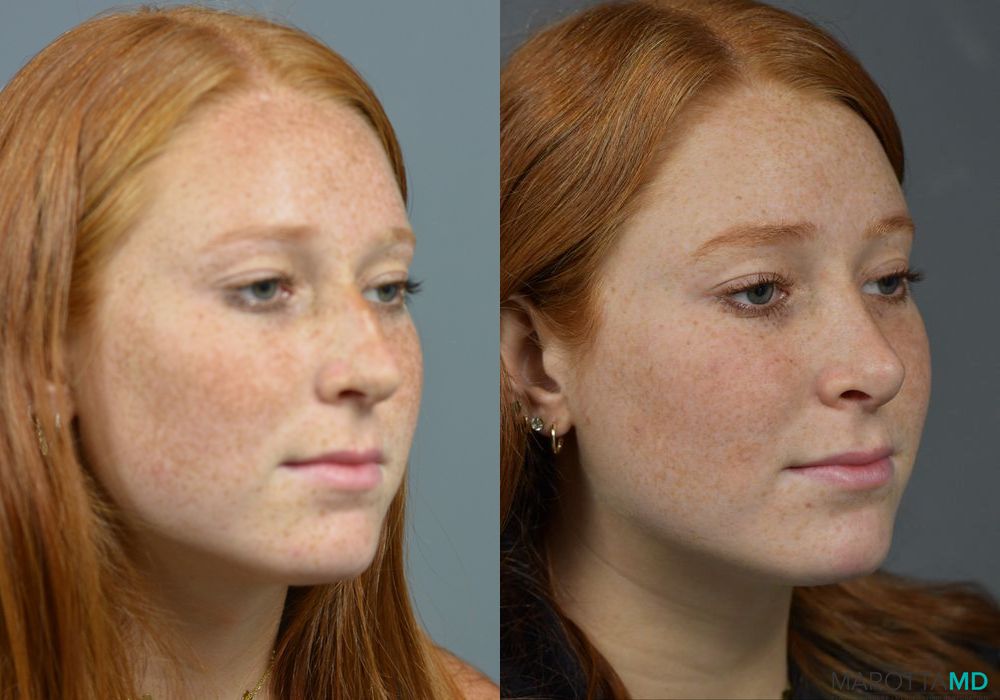 Rhinoplasty - Thumbnail 2