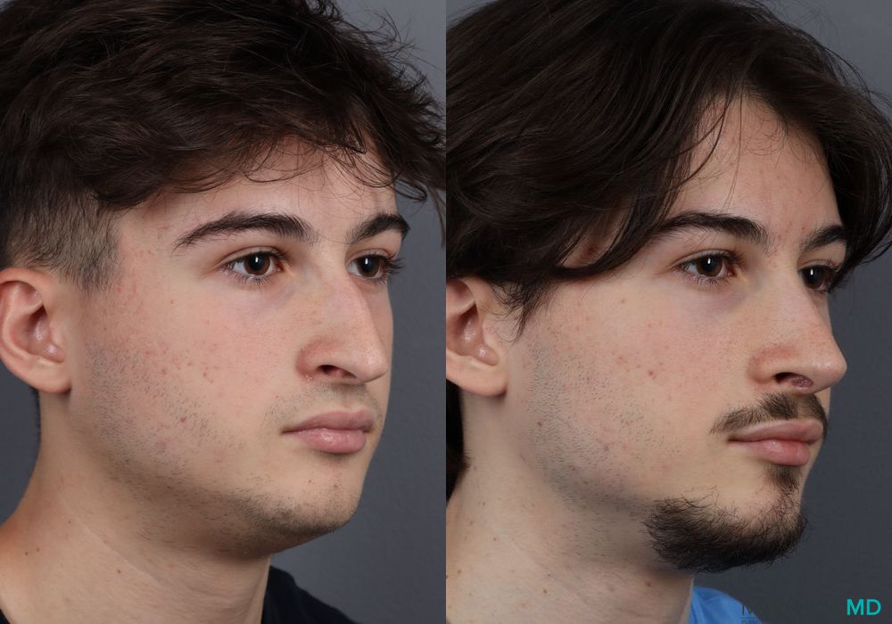 Rhinoplasty - Case 633