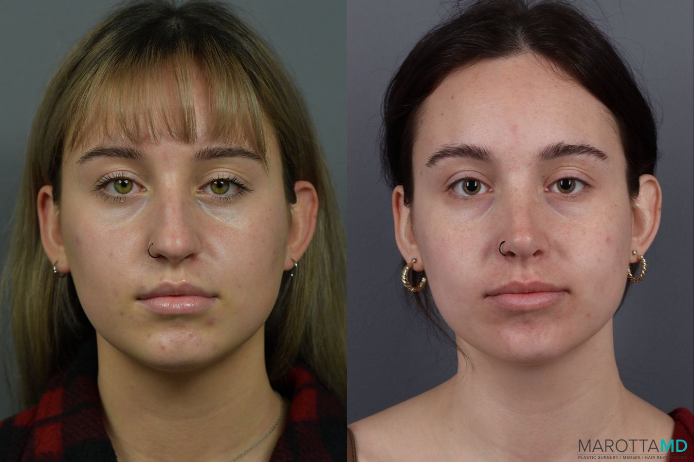 Before and after Rhinoplasty case 12317