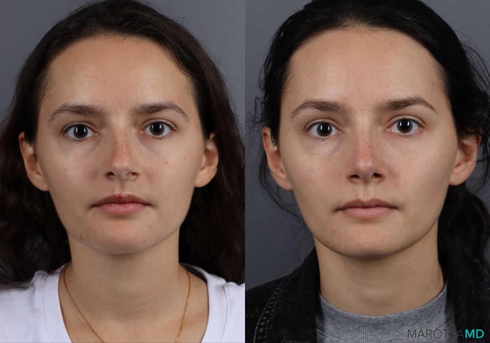 Rhinoplasty - Thumbnail 4