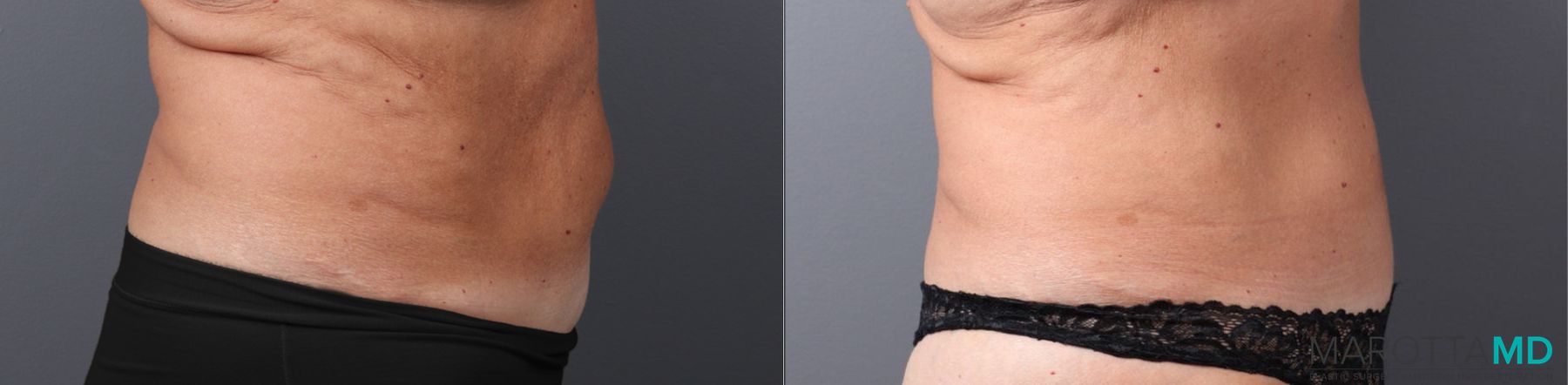 Before and after Tummy Tuck case 41920 - Angle 3