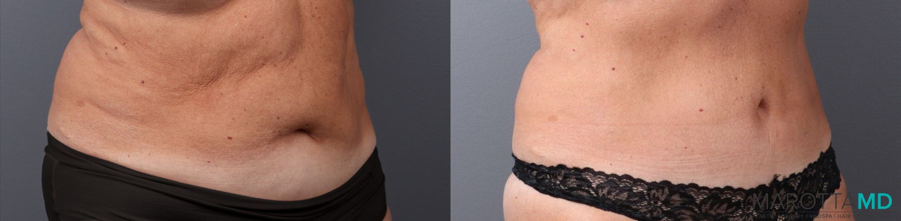 Before and after Tummy Tuck case 41920 - Angle 2