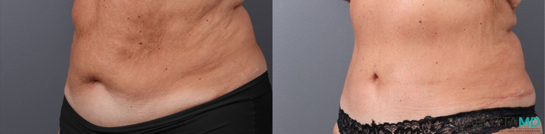Before and after Tummy Tuck case 41920 - Angle 4