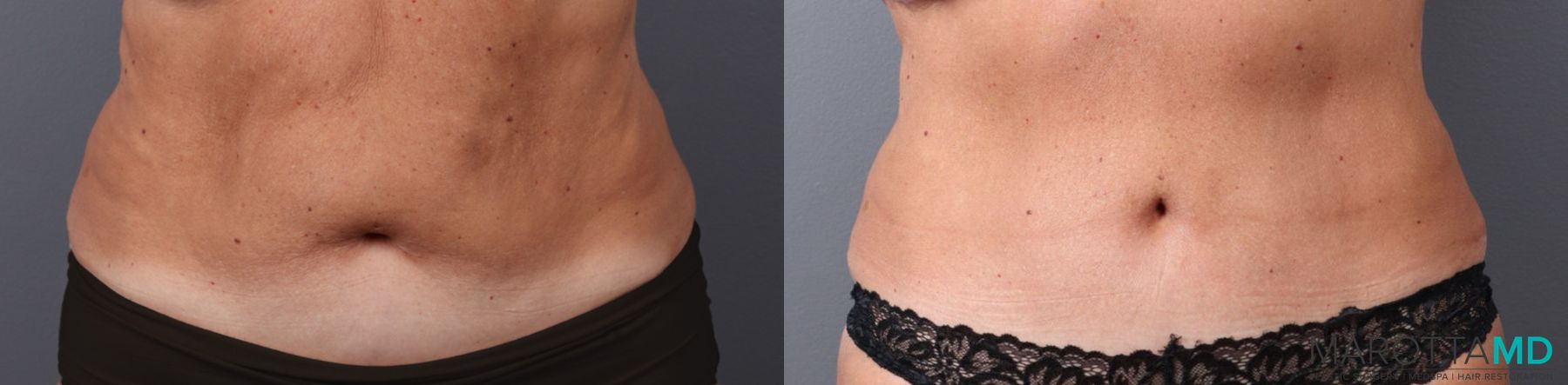 Before and after Tummy Tuck case 41920