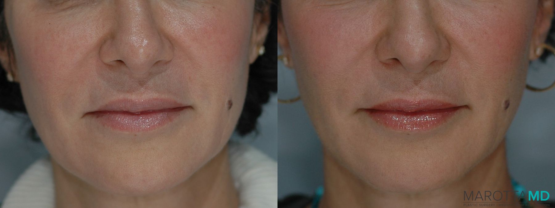 Before and after Ultherapy® case 7235