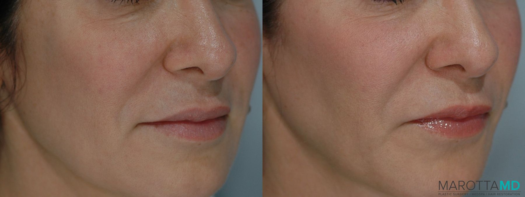Before and after Ultherapy® case 7235 - Angle 2