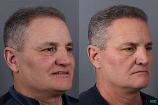 Before and after Hair Transplantation case 21381 - Angle 1