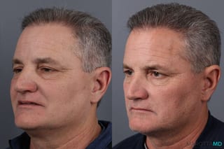 Before and after Hair Transplantation case 21381 - Angle 2