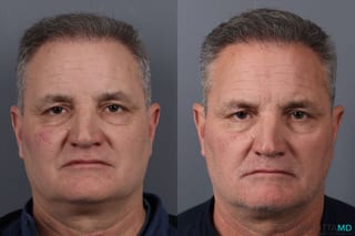 Before and after Hair Transplantation case 21381 - Angle 3