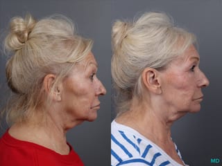 Before and after Genius Radio Frequency Microneedling case 16823 - Angle 4