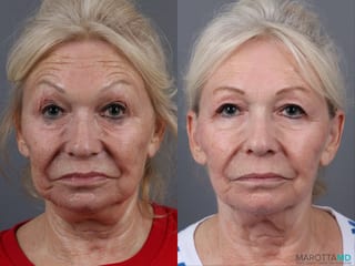 Before and after Genius Radio Frequency Microneedling case 16823 - Angle 5