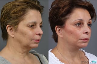 Before and after Facelift & Neck Lift case 41933 - Angle 2