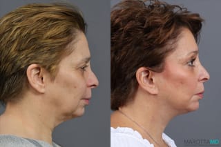 Before and after Facelift & Neck Lift case 41933 - Angle 3