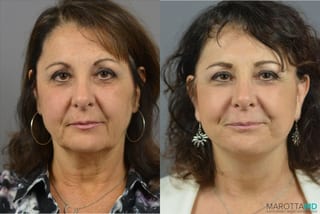 Before and after Mini Facelift case 41931 - Angle 1