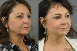 Before and after Mini Facelift case 41931 - Angle 2