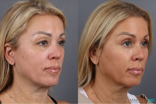 Before and after Fat Transfer - Face case 41929 - Angle 2