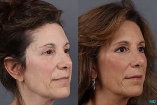 Before and after Blepharoplasty Lower case 41924 - Angle 2