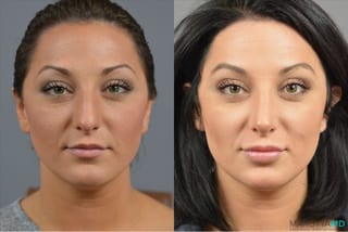 Before and after Rhinoplasty case 41921 - Angle 1