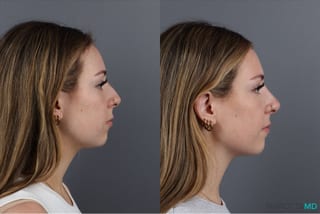 Before and after Non-Surgical Rhinoplasty case 41879 - Angle 3