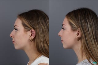Before and after Non-Surgical Rhinoplasty case 41879 - Angle 4