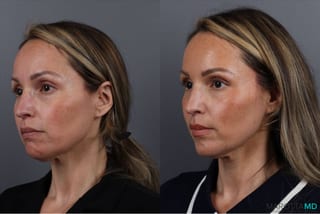 Before and after Botox - Chin case 41878 - Angle 2