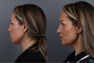 Before and after Botox - Chin case 41878 - Angle 3