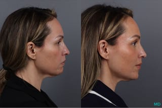 Before and after Botox - Chin case 41878 - Angle 5