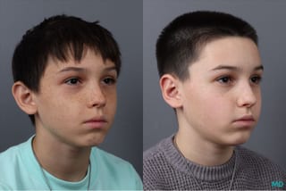 Before and after Otoplasty case 21380 - Angle 2