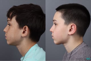 Before and after Otoplasty case 21380 - Angle 5