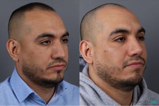 Before and after Rhinoplasty case 21670 - Angle 2