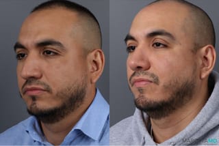 Before and after Rhinoplasty case 21670 - Angle 3