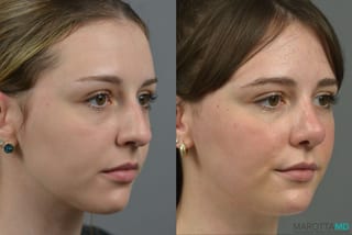 Before and after Rhinoplasty case 23770 - Angle 2