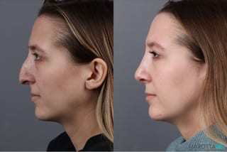 Before and after Rhinoplasty case 41762 - Angle 5