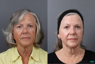 Before and after Laser Skin Resurfacing case 41763 - Angle 1