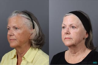 Before and after Laser Skin Resurfacing case 41763 - Angle 4