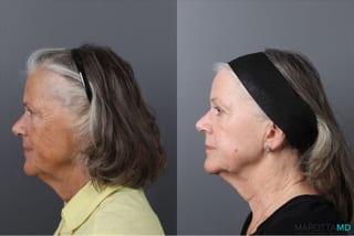 Before and after Laser Skin Resurfacing case 41763 - Angle 5