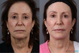 Before and after Facelift & Neck Lift case 41861 - Angle 1