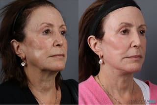 Before and after Facelift & Neck Lift case 41861 - Angle 2