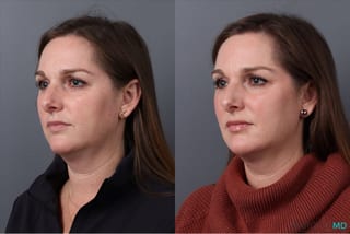 Before and after Botox - Nefertiti Neck Lift case 41875 - Angle 4