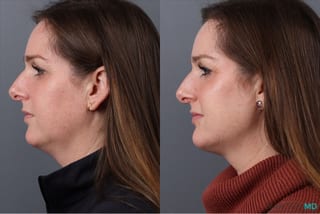 Before and after Botox - Nefertiti Neck Lift case 41875 - Angle 5