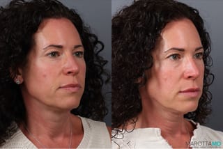 Before and after Botox - DAO case 41872 - Angle 2