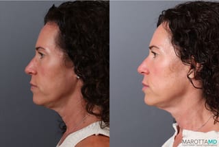 Before and after Botox - DAO case 41872 - Angle 5